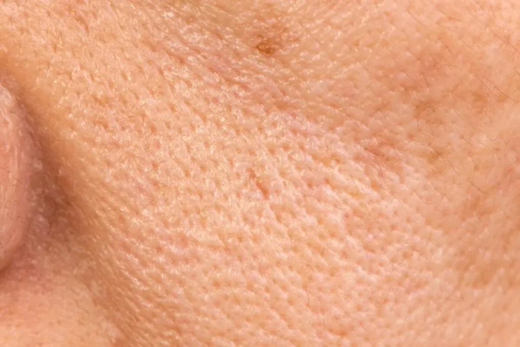 たるみ毛穴 イメージ