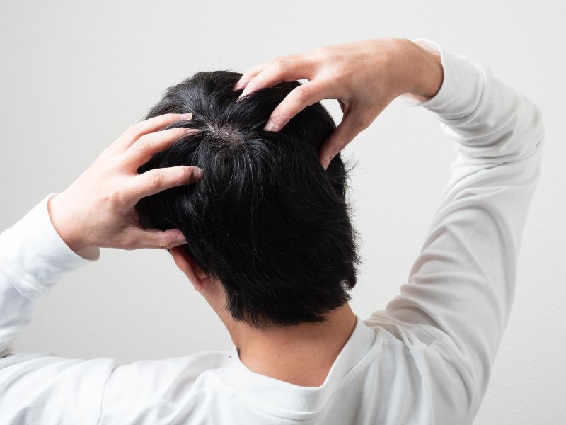 頭皮の痒み　フケ