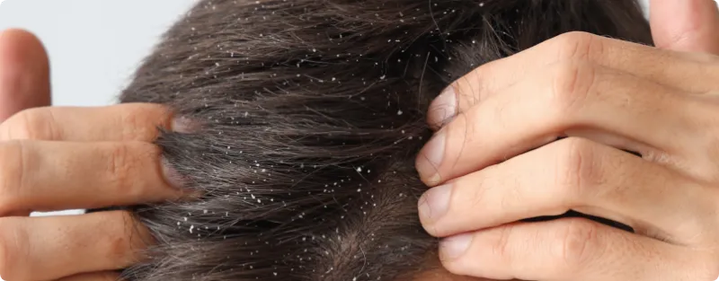 髪のフケ